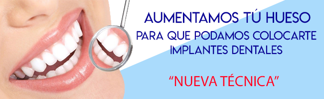 aumento de hueso implantes dentales aumento de hueso implantes dentales